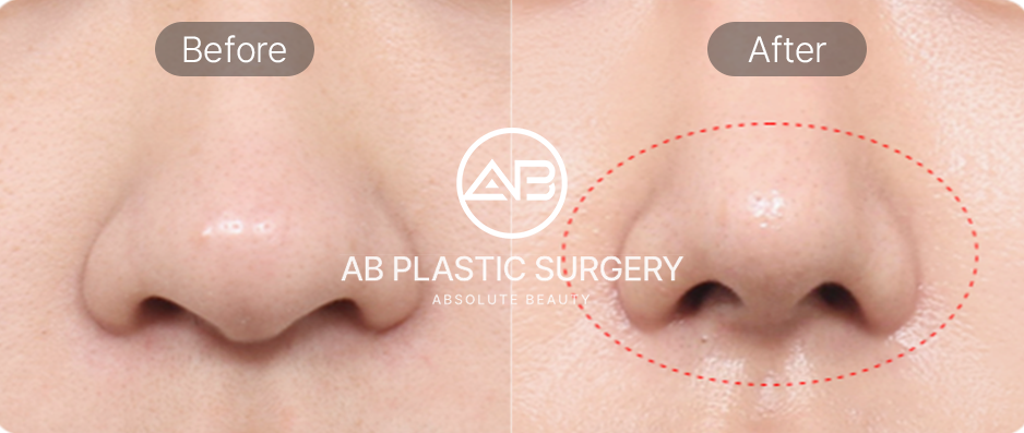 Thu nhỏ cánh mũi – Trước & sau thu gọn cánh mũi