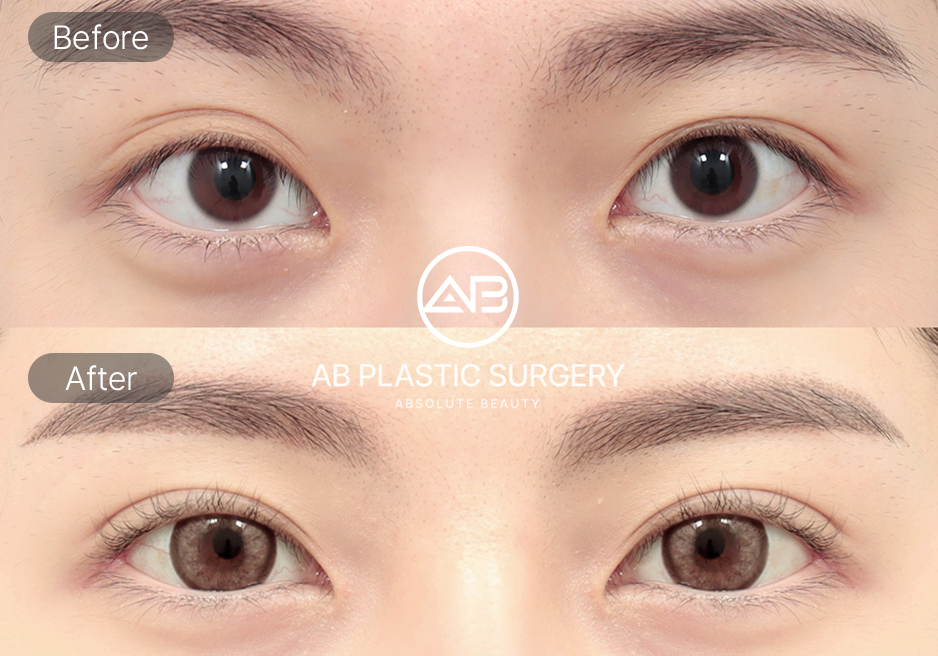 Hình ảnh trước và sau phẫu thuật mắt Hàn Quốc