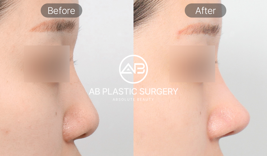 Hình ảnh trước & sau chỉnh sửa đầu mũi tròn