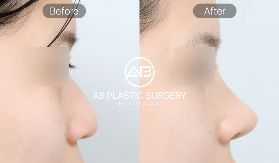 Hình ảnh trước & sau phẫu thuật chỉnh sửa mũi diều hâu