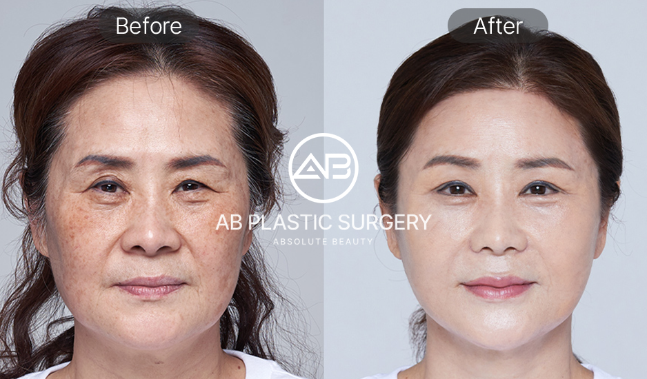 Hình ảnh trước và sau căng chỉ nâng cơ tại Hàn Quốc – Góc chính diện