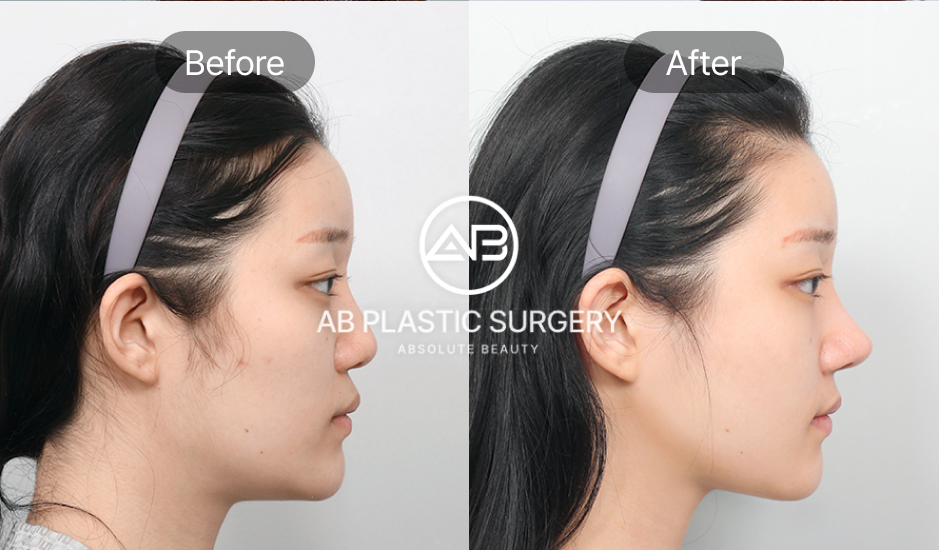 Hình ảnh góc nghiêng phẫu thuật tạo hình khuôn mặt bằng tiếng Việt