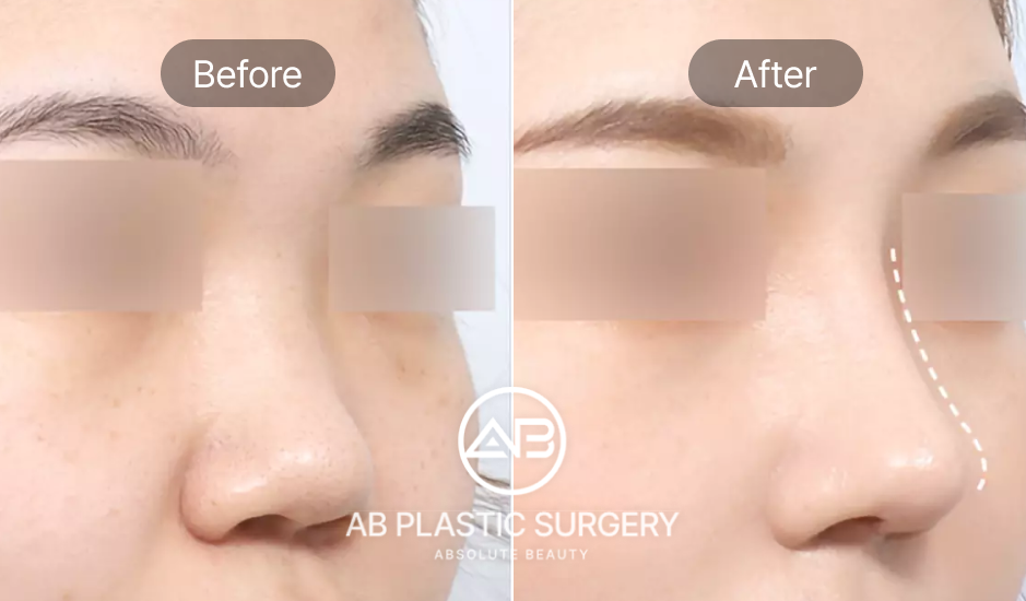 Trước và sau nâng mũi tự nhiên tại Bệnh viện thẩm mỹ AB