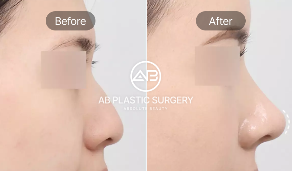 Kết quả nâng mũi sau tư vấn chuyên sâu tại Bệnh viện thẩm mỹ AB