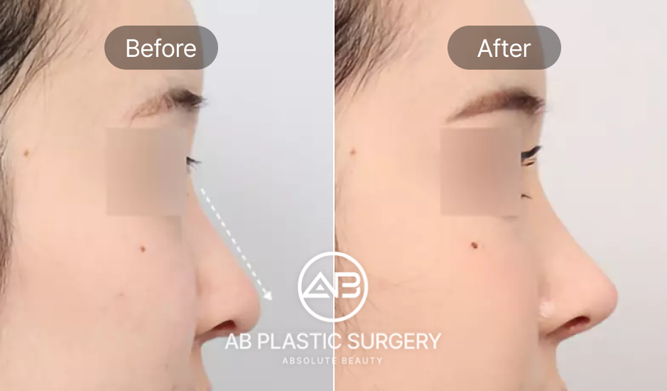 Trước và sau nâng mũi theo tiêu chuẩn Hàn Quốc tại Bệnh viện thẩm mỹ AB