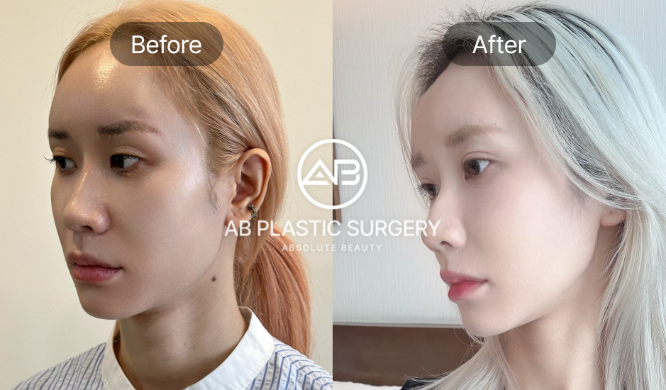 Hình ảnh trước và sau phẫu thuật mắt Hàn Quốc