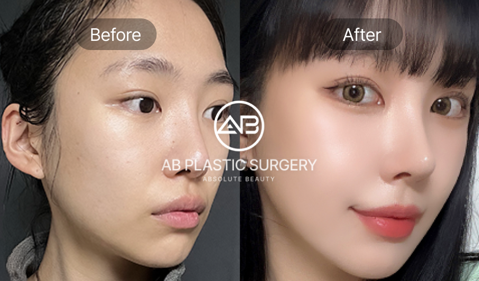 Trường hợp sửa mũi hỏng bằng nâng mũi cấu trúc