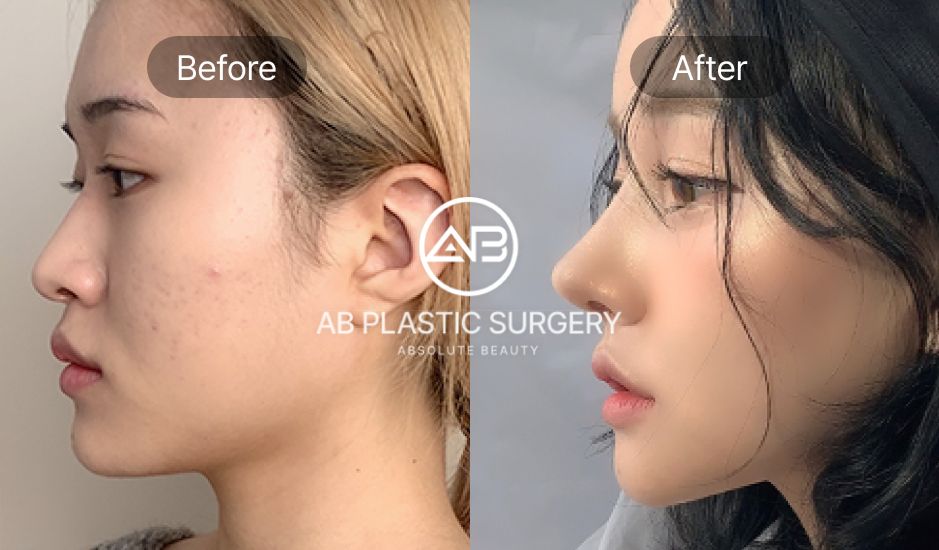 Hình ảnh trước – sau nâng mũi cấu trúc tại Bệnh viện thẩm mỹ AB