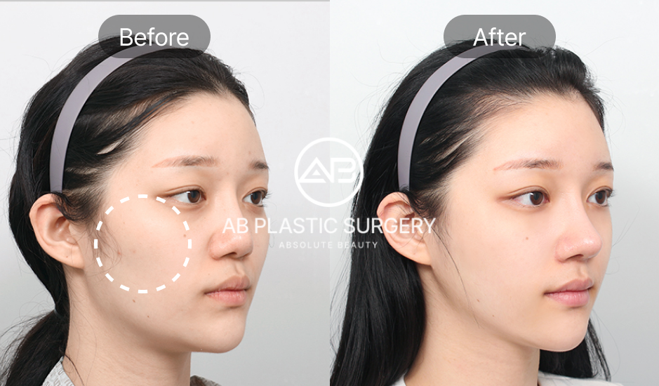 Hình ảnh trước và sau phẫu thuật hạ gò má ở góc 45 độ