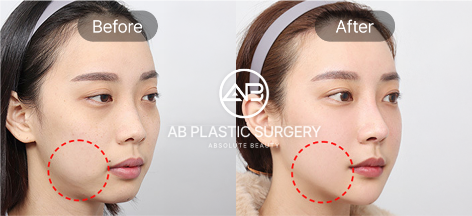 Hình ảnh trước và sau phẫu thuật hạ gò má kết hợp cải thiện má hóp tại Bệnh viện thẩm mỹ AB Hàn Quốc