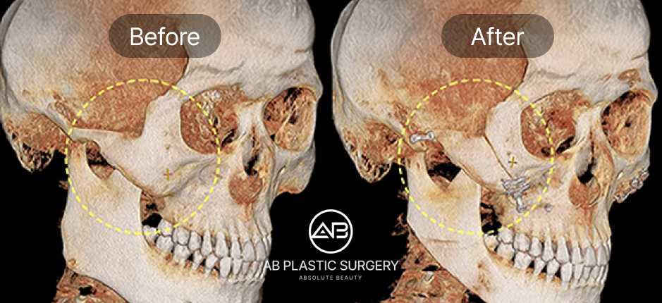 Hình ảnh CT 3D trước và sau phẫu thuật hạ gò má tại Bệnh viện thẩm mỹ AB Hàn Quốc