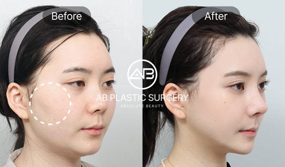 Hình ảnh trước và sau phẫu thuật hạ gò má tại Bệnh viện thẩm mỹ AB Hàn Quốc
