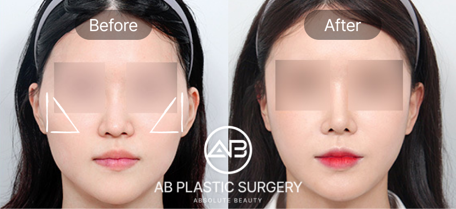 Trước sau hạ gò má tại Bệnh viện thẩm mỹ AB Hàn Quốc
