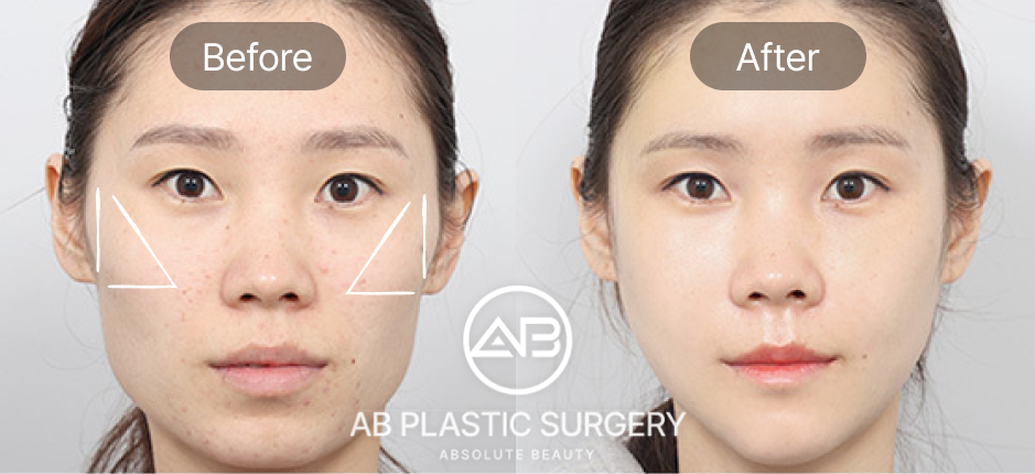 Trước sau hạ gò má tại Bệnh viện thẩm mỹ AB Hàn Quốc