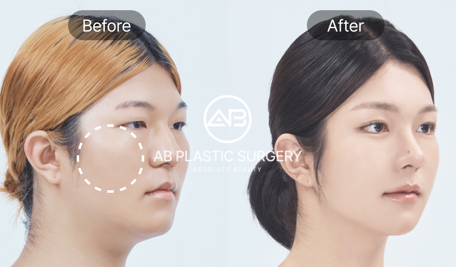Trước sau hạ gò má tại Bệnh viện thẩm mỹ AB Hàn Quốc