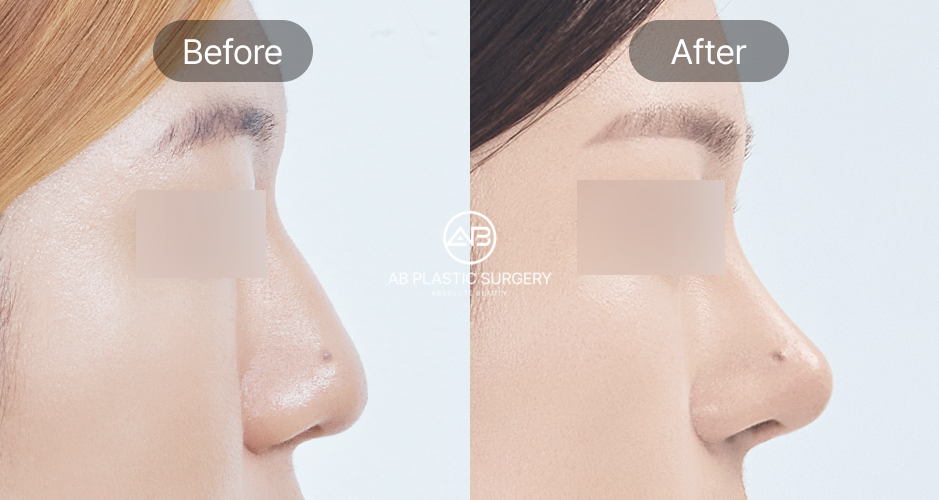 Trước và sau phẫu thuật sửa mũi diều hâu tại Bệnh viện thẩm mỹ AB Hàn Quốc – sống mũi gồ cao được làm phẳng, tạo dáng mũi mềm mại hơn