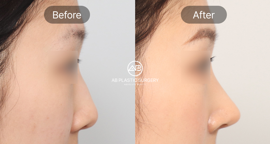 Kết quả phẫu thuật mũi diều hâu – sống mũi sau khi chỉnh sửa tại Bệnh viện thẩm mỹ AB trở nên hài hòa và thanh thoát hơn