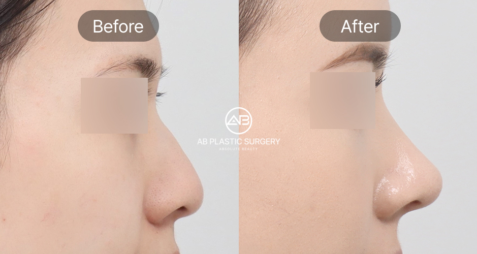 Hình ảnh góc nghiêng trước – sau sửa mũi diều hâu tại AB Hàn Quốc, sống mũi cao được chỉnh hình mềm mại, giúp gương mặt hài hòa hơn