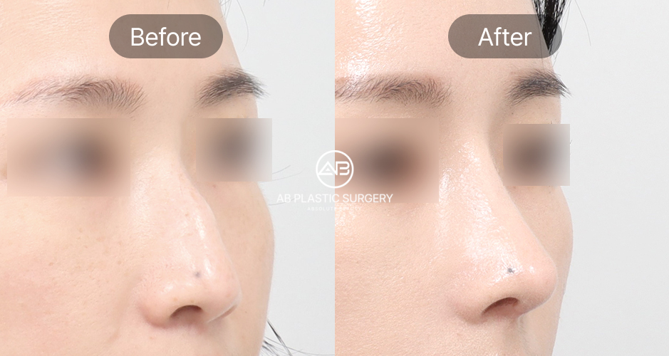 Hình ảnh trước – sau sửa mũi diều hâu góc chéo tại Bệnh viện thẩm mỹ AB Hàn Quốc