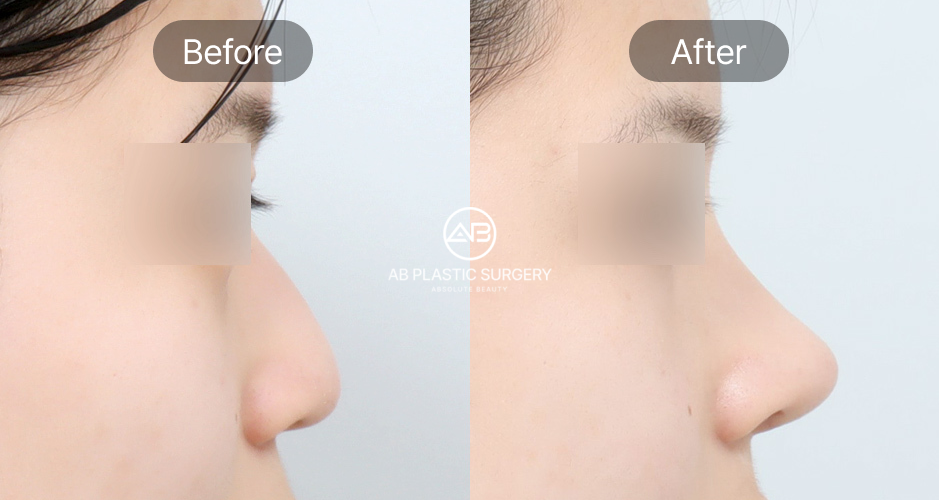 Hình ảnh trước – sau phẫu thuật sửa mũi diều hâu nhìn nghiêng tại Bệnh viện thẩm mỹ AB Hàn Quốc