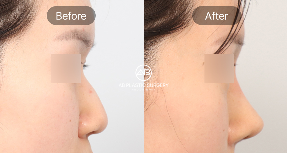 Hình ảnh trước – sau chỉnh hình mũi diều hâu tại Bệnh viện thẩm mỹ AB Hàn Quốc – sống mũi cong được làm mượt và thanh thoát