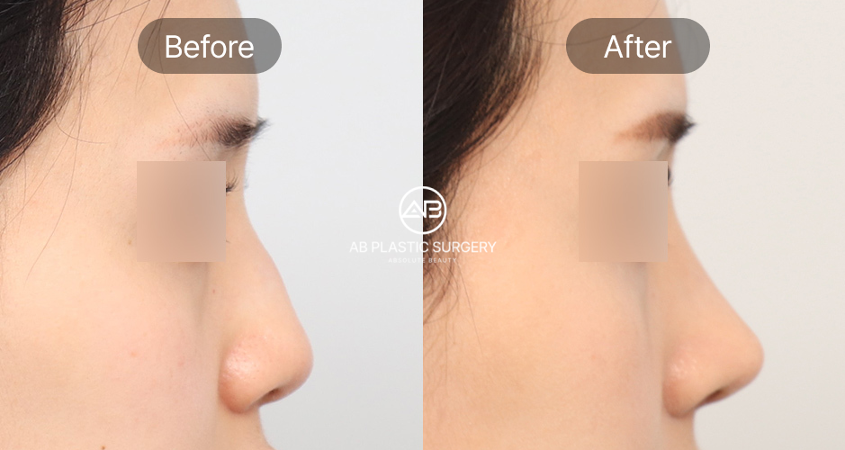 Hình ảnh trước – sau chỉnh sửa mũi diều hâu tại Bệnh viện thẩm mỹ AB Hàn Quốc – đường sống mũi được làm mềm mại và hài hòa hơn
