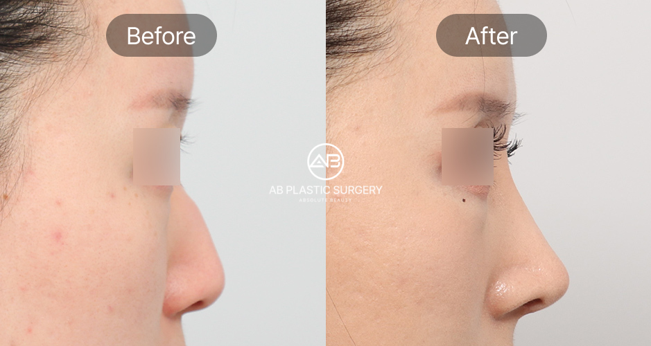 Hình ảnh trước – sau chỉnh sửa mũi diều hâu từ góc nghiêng tại Bệnh viện thẩm mỹ AB Hàn Quốc – sống mũi sau phẫu thuật trở nên thanh thoát và cân đối