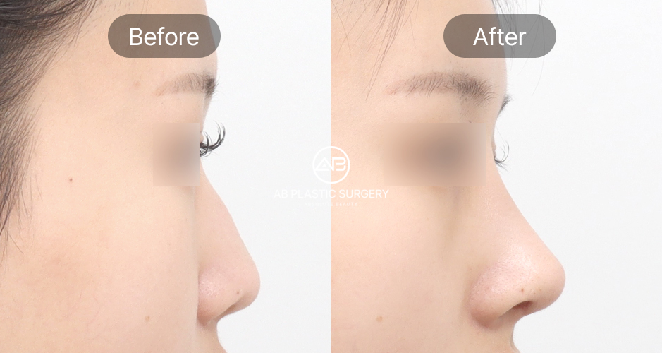 Trước – sau phẫu thuật sửa mũi diều hâu tại AB Plastic Surgery – sống mũi được làm mượt, góc nghiêng hài hòa hơn