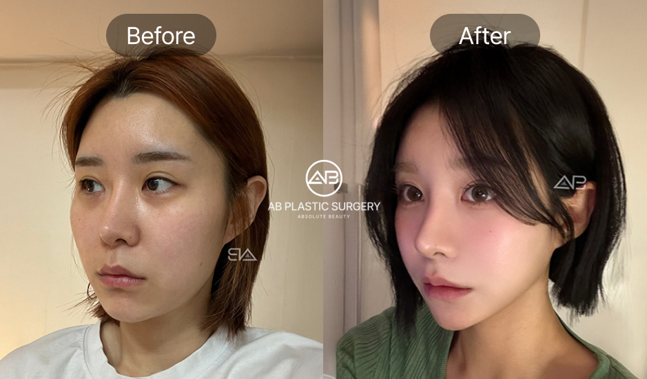 Hình ảnh trước và sau phẫu thuật tại Bệnh viện thẩm mỹ AB Hàn Quốc