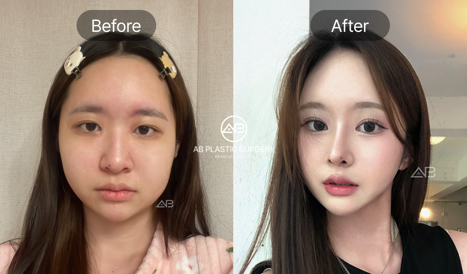 Hình ảnh so sánh trước và sau phẫu thuật tại Bệnh viện thẩm mỹ AB Hàn Quốc – gương mặt thon gọn, đường nét sắc sảo và phong cách thay đổi rõ rệt.