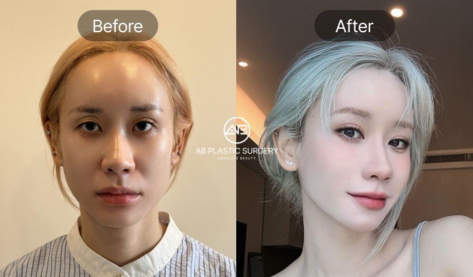 Hình ảnh Before & After của khách hàng Việt sau khi phẫu thuật tại Bệnh viện thẩm mỹ AB Hàn Quốc – thay đổi rõ rệt với gương mặt cân đối và đường nét thanh tú.