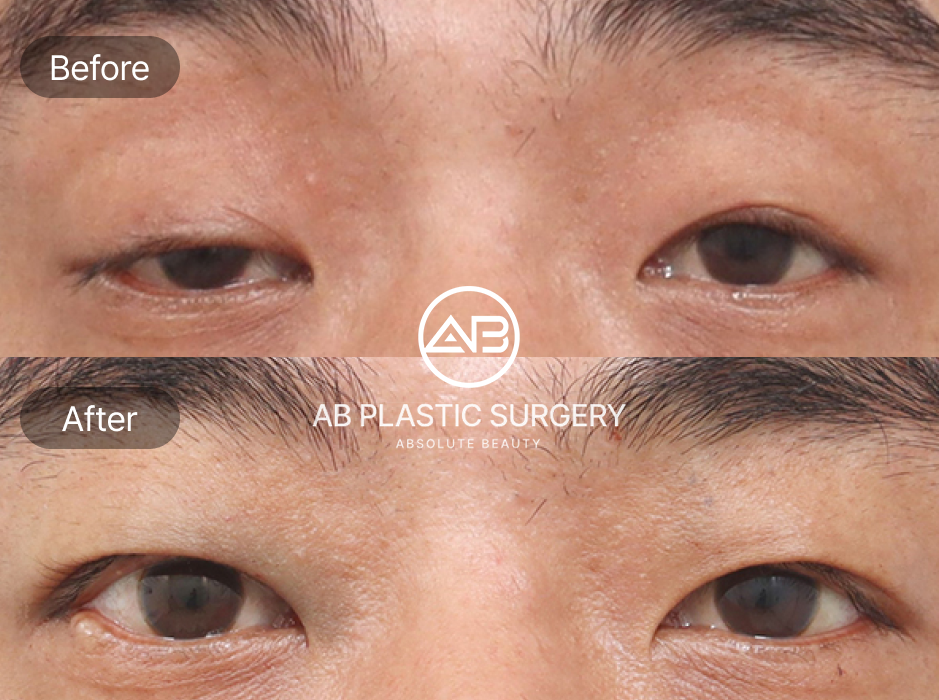 Hình ảnh trước và sau phẫu thuật mí sụp (ptosis) tại Bệnh viện thẩm mỹ AB Hàn Quốc – cải thiện mí nặng, mở rộng tầm nhìn rõ rệt