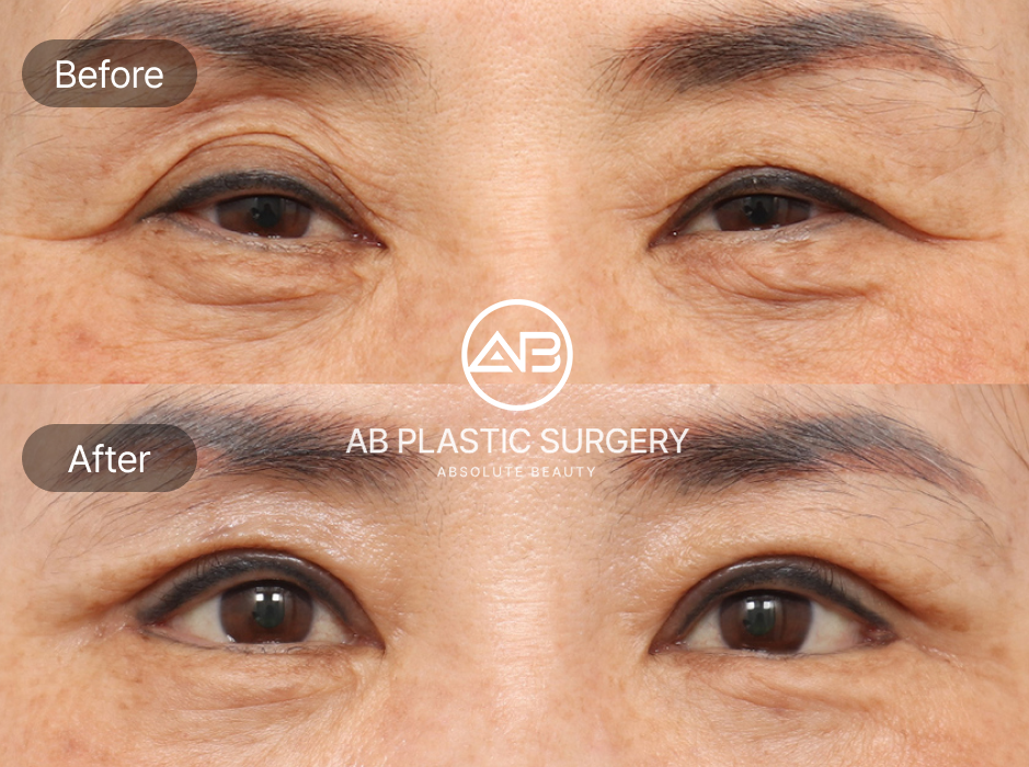 Ảnh trước sau phẫu thuật mí sụp do lão hóa tại Bệnh viện thẩm mỹ AB Hàn Quốc – cải thiện mí chùng, đôi mắt trẻ trung và sáng rõ hơn