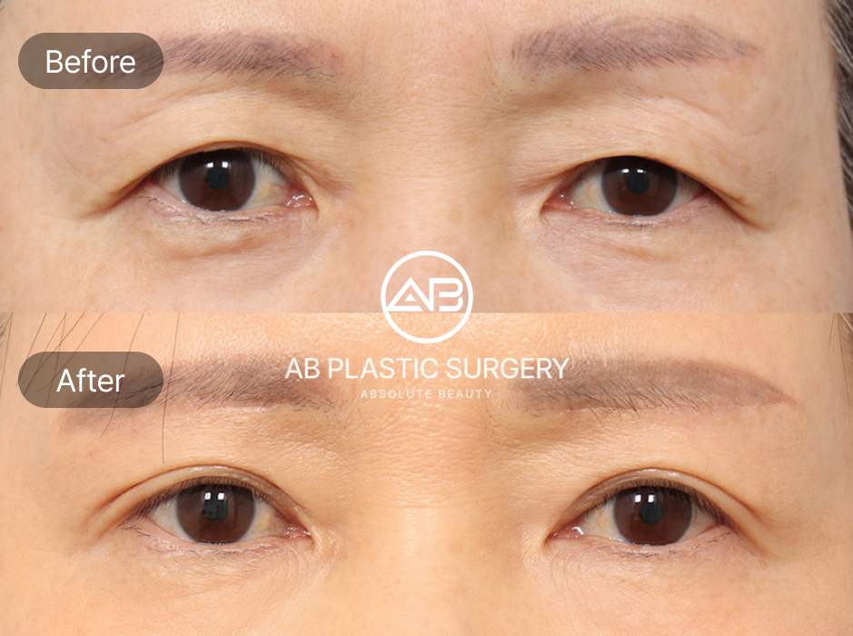 Ảnh trước sau phẫu thuật điều trị mí sụp tại Bệnh viện thẩm mỹ AB Hàn Quốc – loại bỏ da chùng, cải thiện cơ nâng mi và mang lại đôi mắt tươi trẻ
