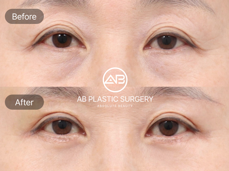 Ảnh trước sau phẫu thuật cắt mí trên (Upper Blepharoplasty) tại Bệnh viện thẩm mỹ AB Hàn Quốc – loại bỏ da chùng, mở rộng tầm nhìn và trẻ hóa gương mặt