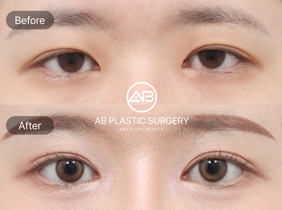 Ảnh trước sau phẫu thuật mí sụp tại Bệnh viện thẩm mỹ AB Hàn Quốc – mí mắt nặng nề được cải thiện, mắt mở to và gương mặt trẻ trung hơn