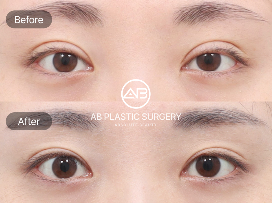 Ảnh trước sau phẫu thuật mí sụp tại Bệnh viện thẩm mỹ AB Hàn Quốc – đôi mắt mở to, tự nhiên và hài hòa hơn sau điều trị