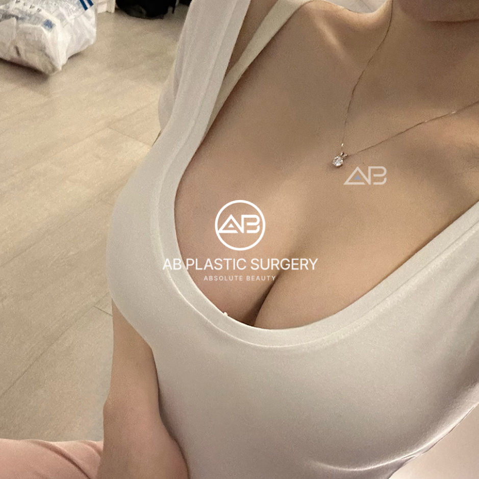 Hình ảnh kết quả sau phẫu thuật treo ngực sa trễ tại Bệnh viện thẩm mỹ AB Hàn Quốc – vòng một săn chắc, đầy đặn và cân đối tự nhiên