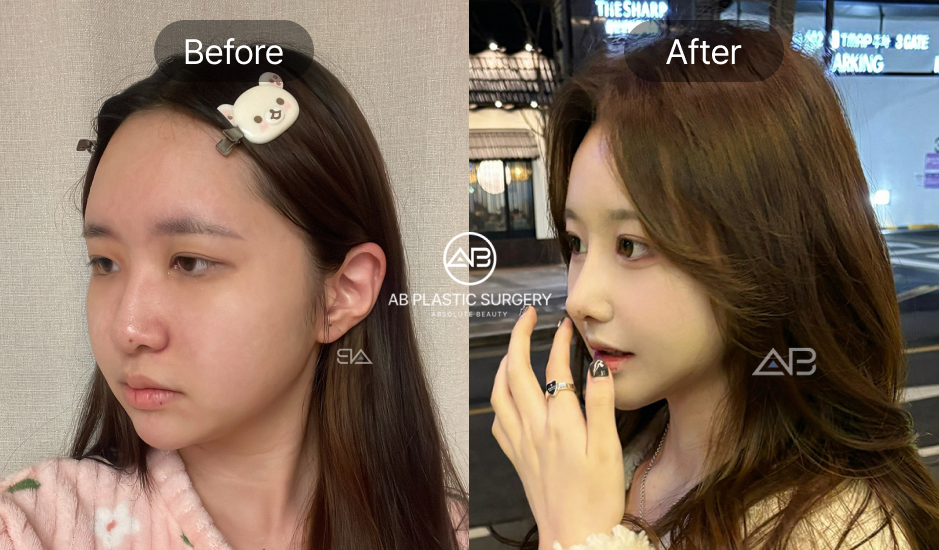 Hình ảnh trước và sau nâng mũi tự nhiên cho người có mũi to, cánh mũi bè, đầu mũi thô – Thực hiện tại Bệnh viện thẩm mỹ AB Hàn Quốc