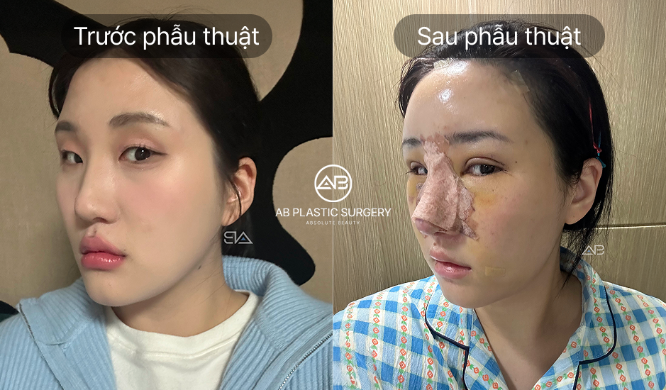 Hình ảnh trước và sau phẫu thuật nâng mũi tự nhiên tại Bệnh viện thẩm mỹ AB Hàn Quốc – Thay đổi dáng mũi rõ rệt nhưng vẫn giữ vẻ đẹp tự nhiên