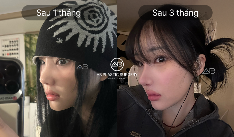 Hình ảnh sau 1 tháng và 3 tháng nâng mũi tự nhiên tại Bệnh viện thẩm mỹ AB Hàn Quốc – Dáng mũi hài hòa, vẫn giữ được nét riêng của từng khách hàng