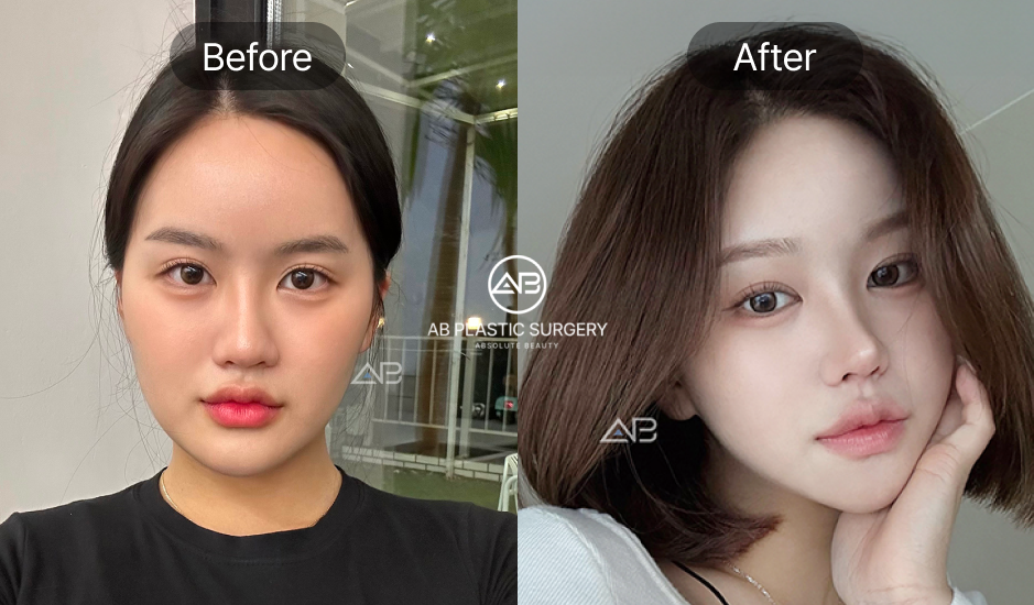 Hình ảnh trước và sau phẫu thuật khuôn mặt nhỏ tại Bệnh viện thẩm mỹ AB