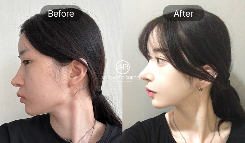 Ảnh nghiêng trước và sau phẫu thuật khuôn mặt nhỏ – Gọt hàm, chỉnh cằm tại Bệnh viện thẩm mỹ AB