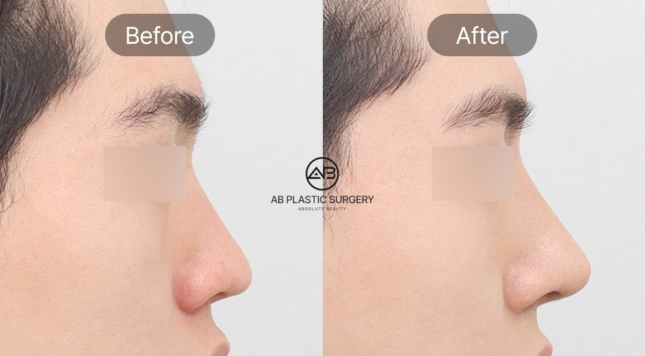 Hình ảnh trước và sau nâng mũi nam với thu gọn cánh mũi và đầu mũi thon gọn hơn, giúp dáng mũi nam sắc nét tự nhiên