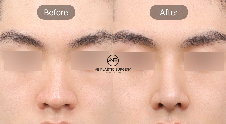 Trước và sau nâng mũi nam Hàn Quốc tại Bệnh viện thẩm mỹ AB Hàn Quốc, cải thiện mũi lệch, mũi gồ, mũi ngắn và dáng mũi nam tự nhiên