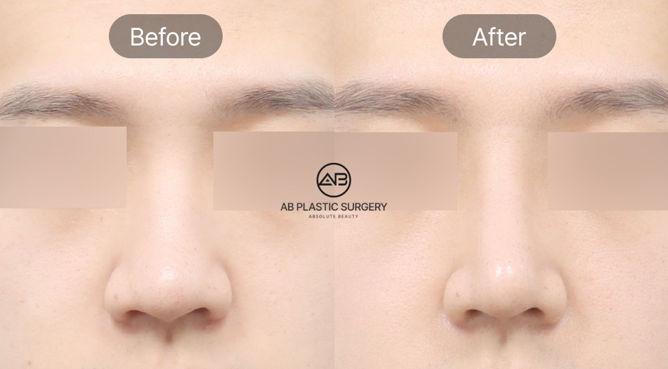 Trước và sau nâng mũi nam Hàn Quốc tại Bệnh viện thẩm mỹ AB Hàn Quốc theo quy trình chuẩn với phân tích 3D CT và thiết kế cá nhân hóa